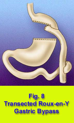 The RNY procedure disconnects most of the stomach and the duodenum